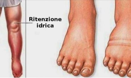 Ritenzione idrica e sintomi